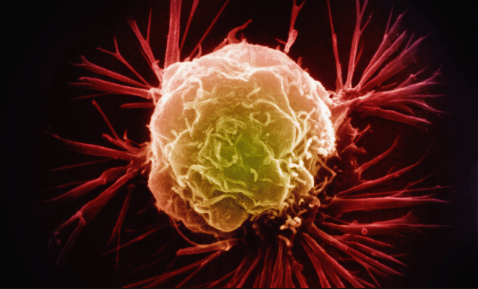 A false-colour electron micrograph image of a breast cancer cell.